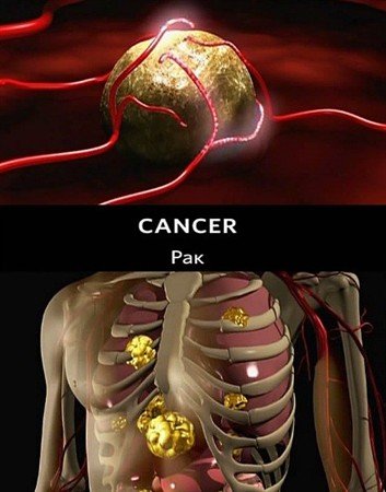 ��� (2 ����� �� 2)  / Cancer (2009) SATRip